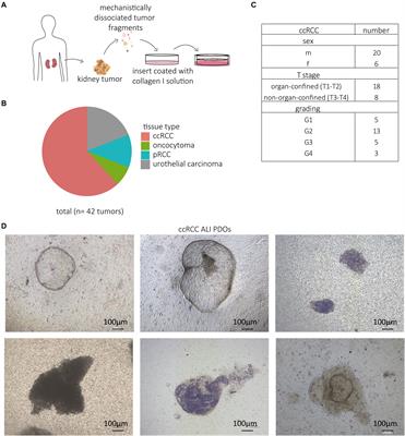 Cultivation of Clear Cell Renal Cell Carcinoma Patient-Derived Organoids in an Air-Liquid Interface System as a Tool for Studying Individualized Therapy